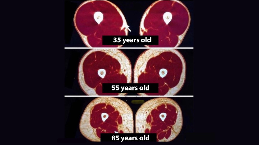 muscle lost over the years sarcopenia